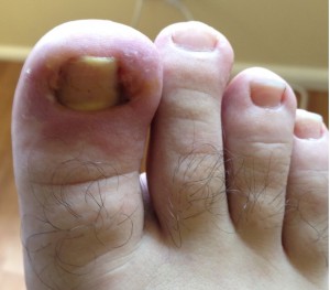 ingrown nail
